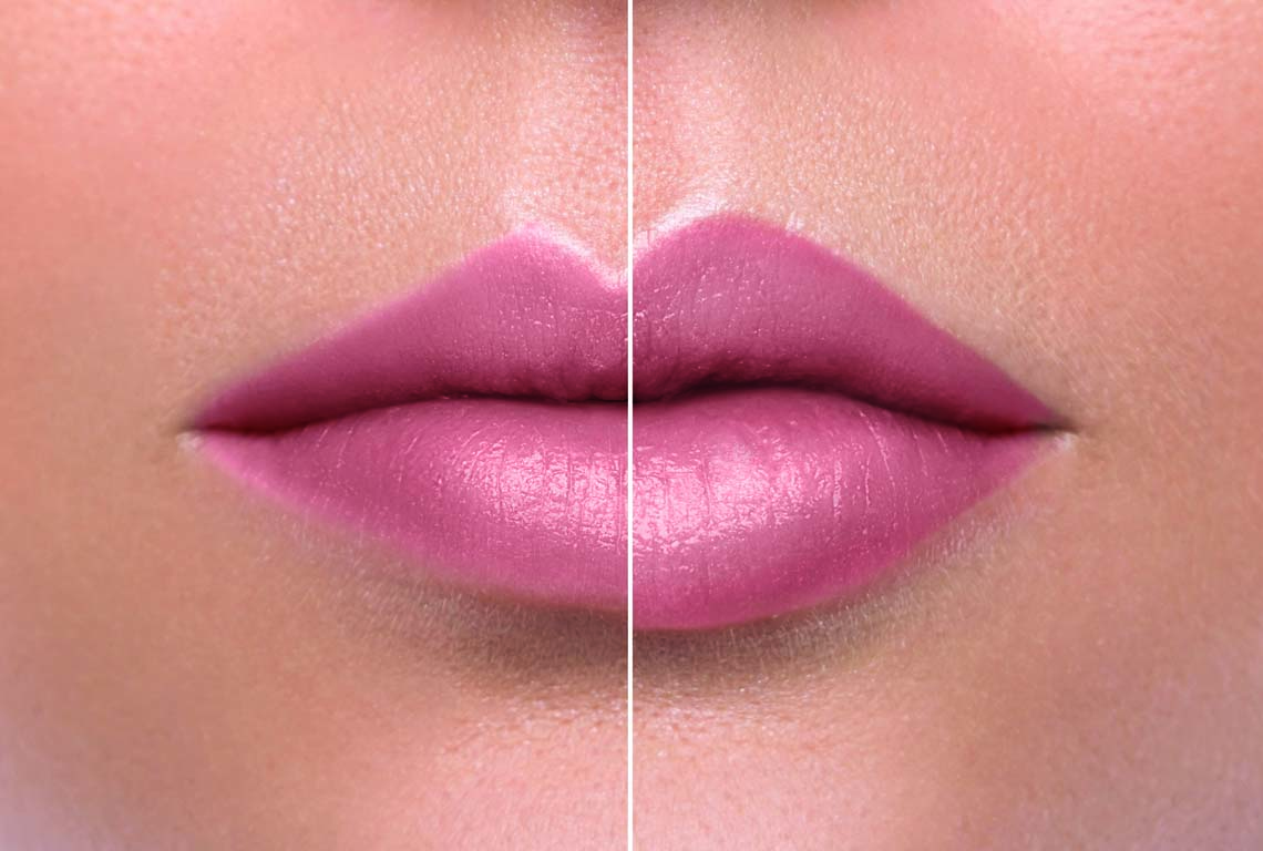 acido_hialuronico_labios