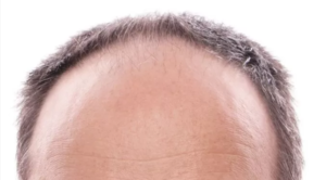 alopecia